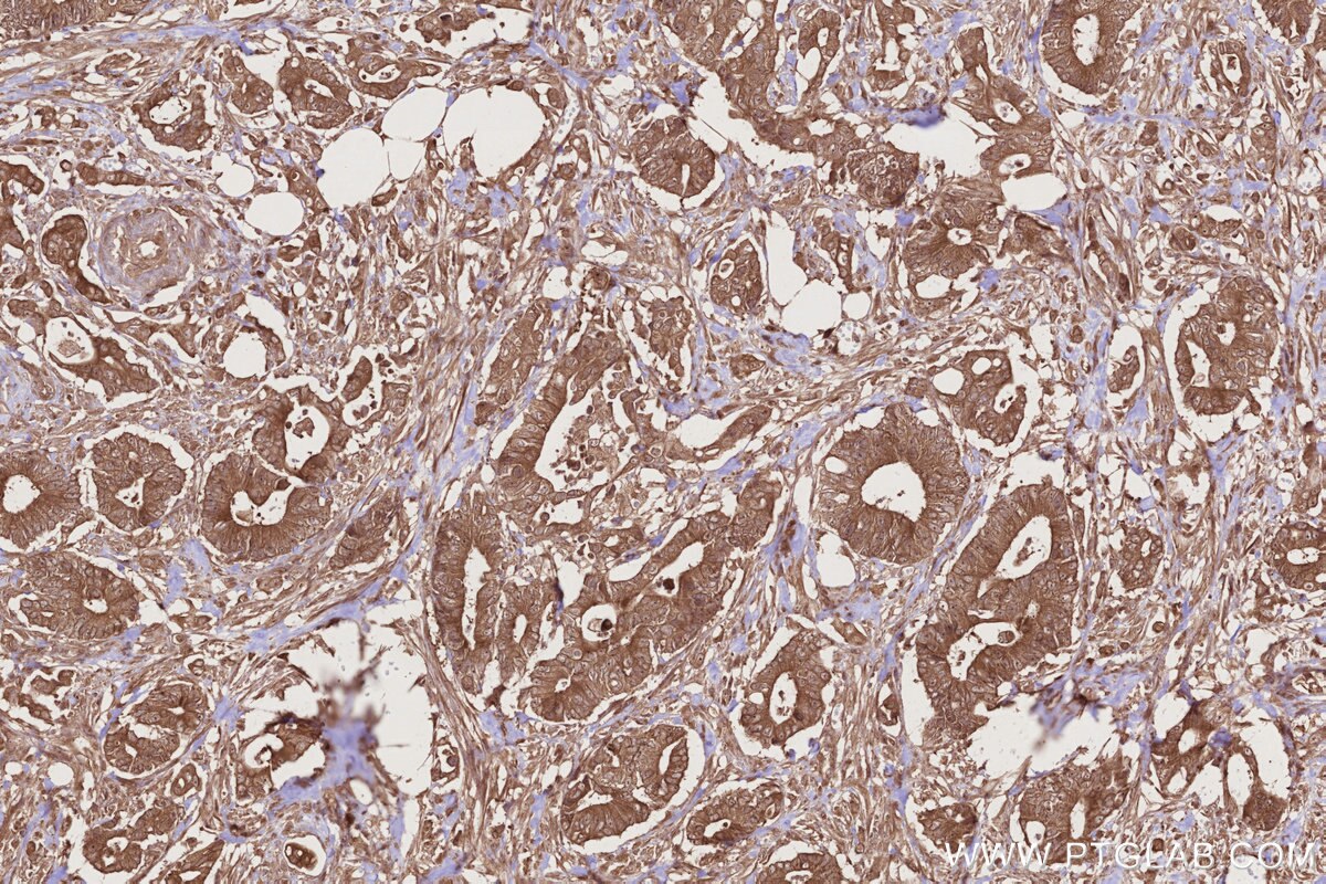 Immunohistochemical analysis of paraffin-embedded human rectal cancer tissue slide using KHC2736 (SCFD1 IHC Kit).