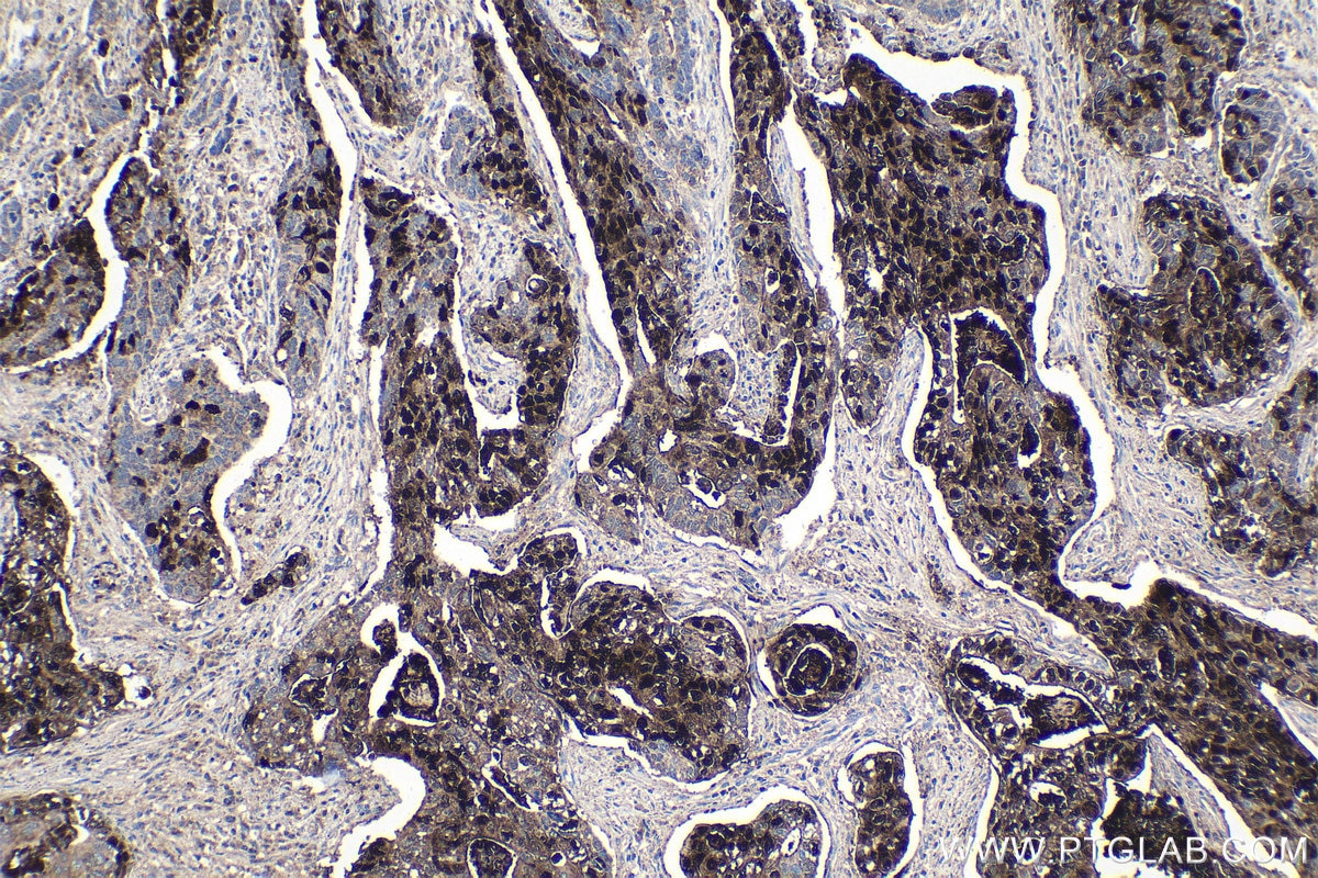 Immunohistochemical analysis of paraffin-embedded human stomach cancer tissue slide using KHC1373 (SDCBP2 IHC Kit).