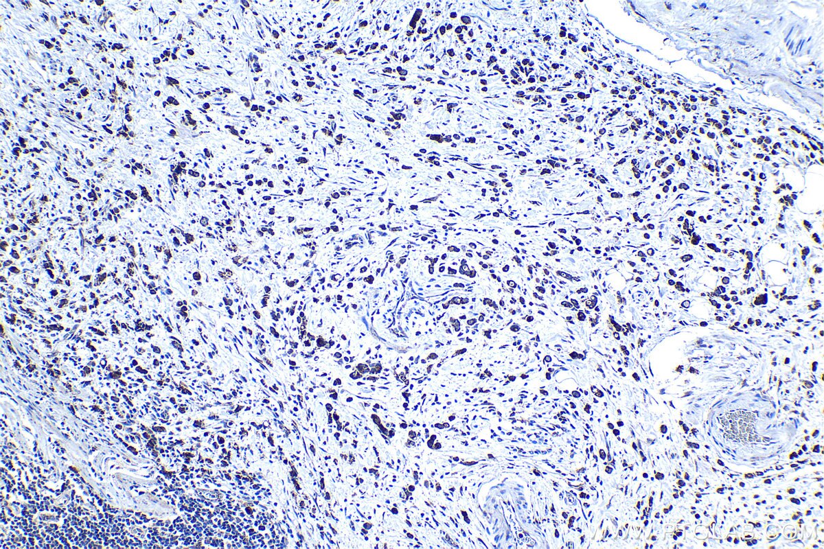 Immunohistochemical analysis of paraffin-embedded human stomach cancer tissue slide using KHC1250 (SDF4 IHC Kit).
