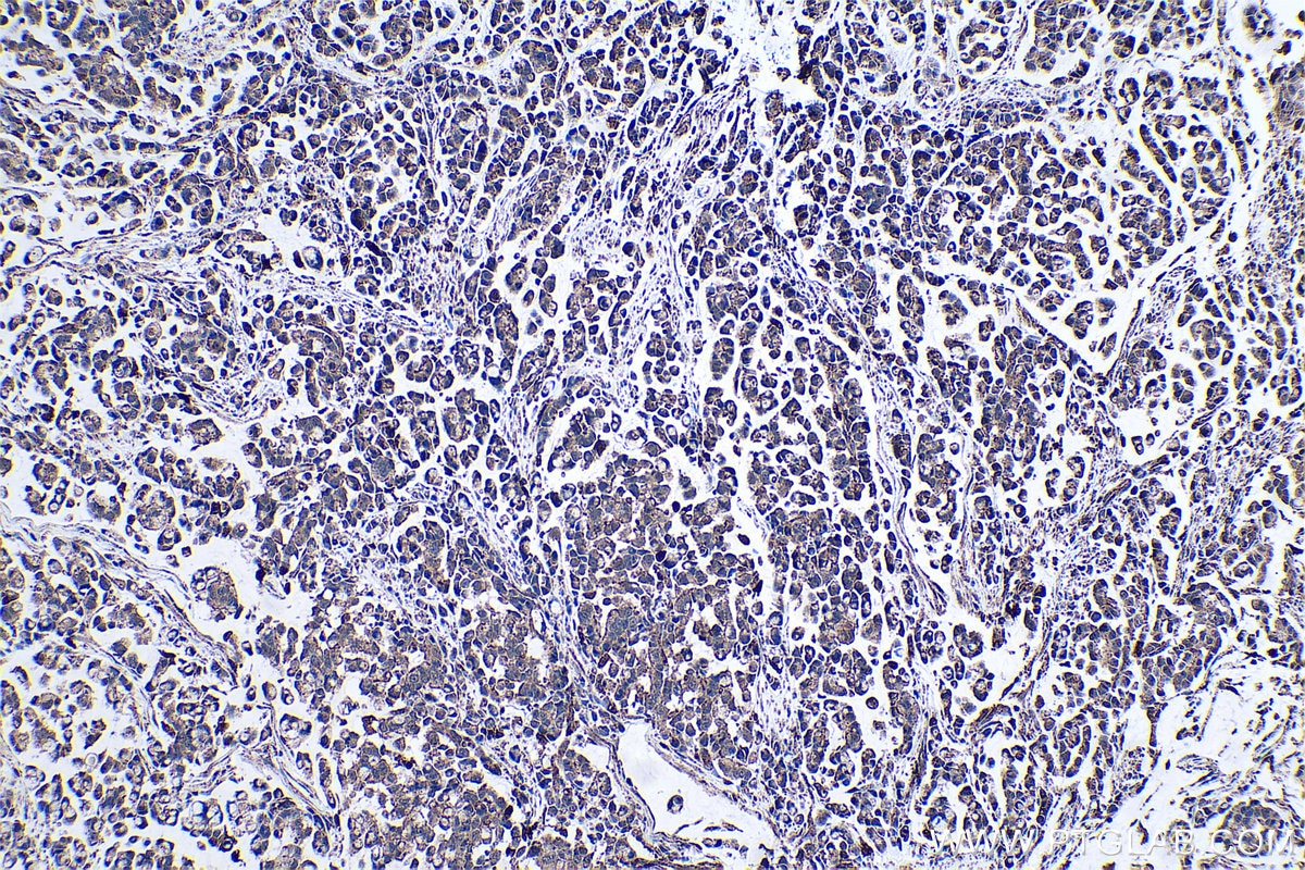 Immunohistochemical analysis of paraffin-embedded human colon cancer tissue slide using KHC0457 (SDSL IHC Kit).