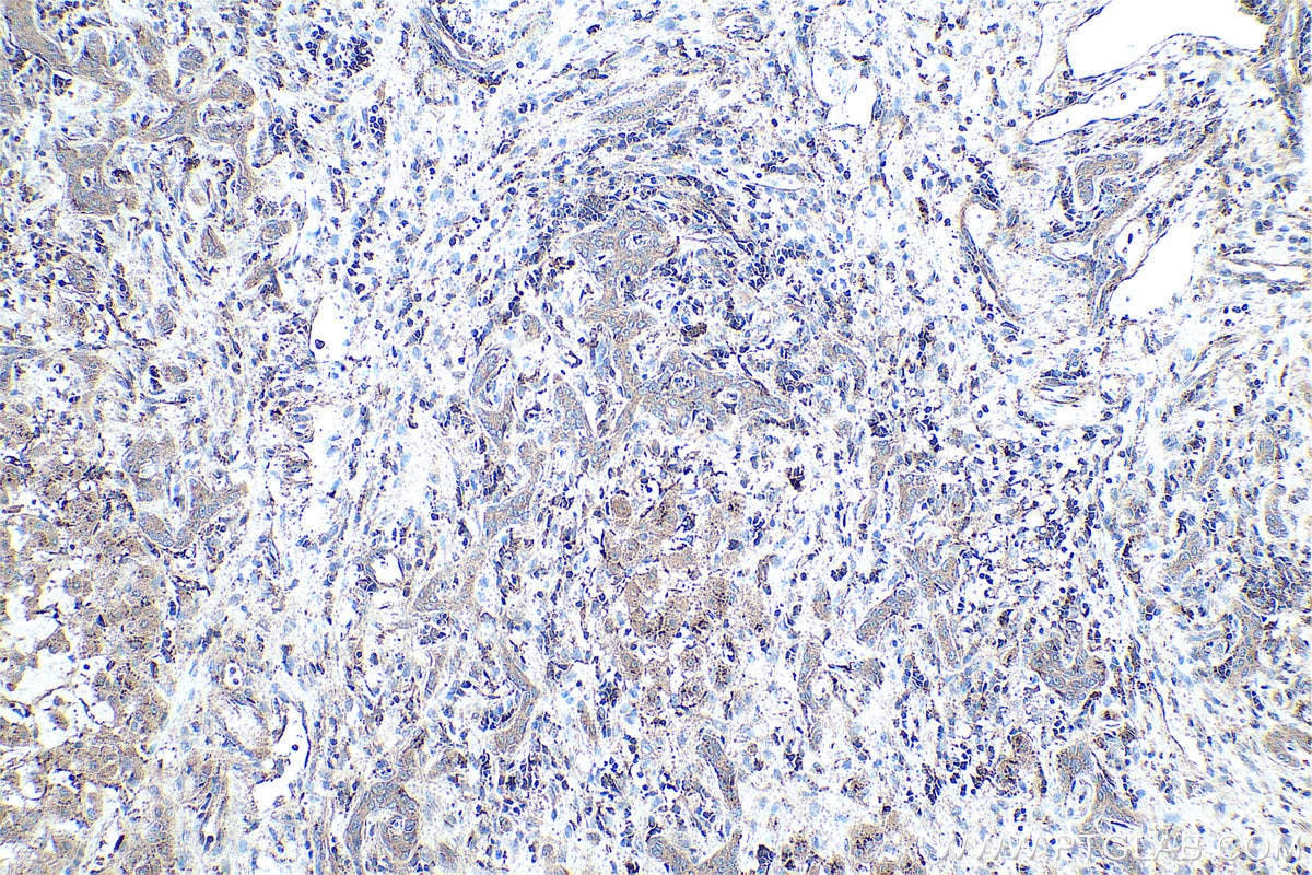 Immunohistochemical analysis of paraffin-embedded human liver cancer tissue slide using KHC0457 (SDSL IHC Kit).