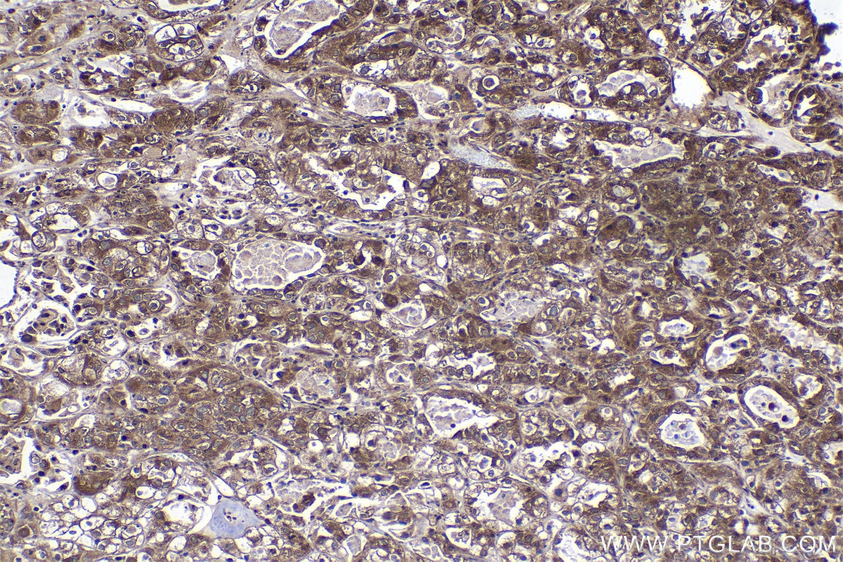 Immunohistochemical analysis of paraffin-embedded human endometrial cancer tissue slide using KHC2066 (SEC16A IHC Kit).