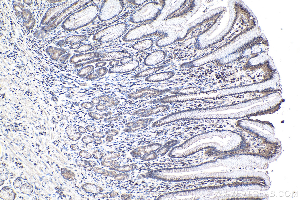 Immunohistochemical analysis of paraffin-embedded human stomach cancer tissue slide using KHC0994 (SEC24C IHC Kit).
