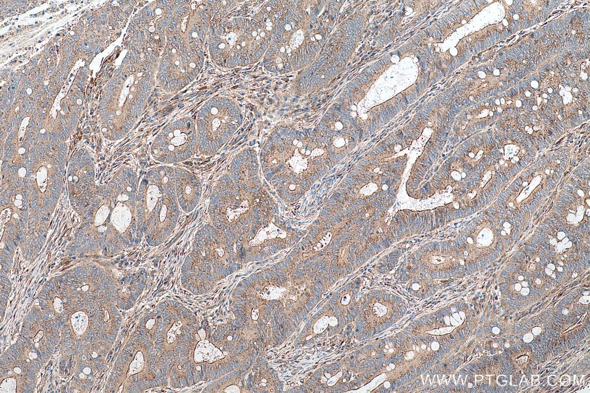 Immunohistochemical analysis of paraffin-embedded human colon cancer tissue slide using KHC0703 (SEC31A IHC Kit).