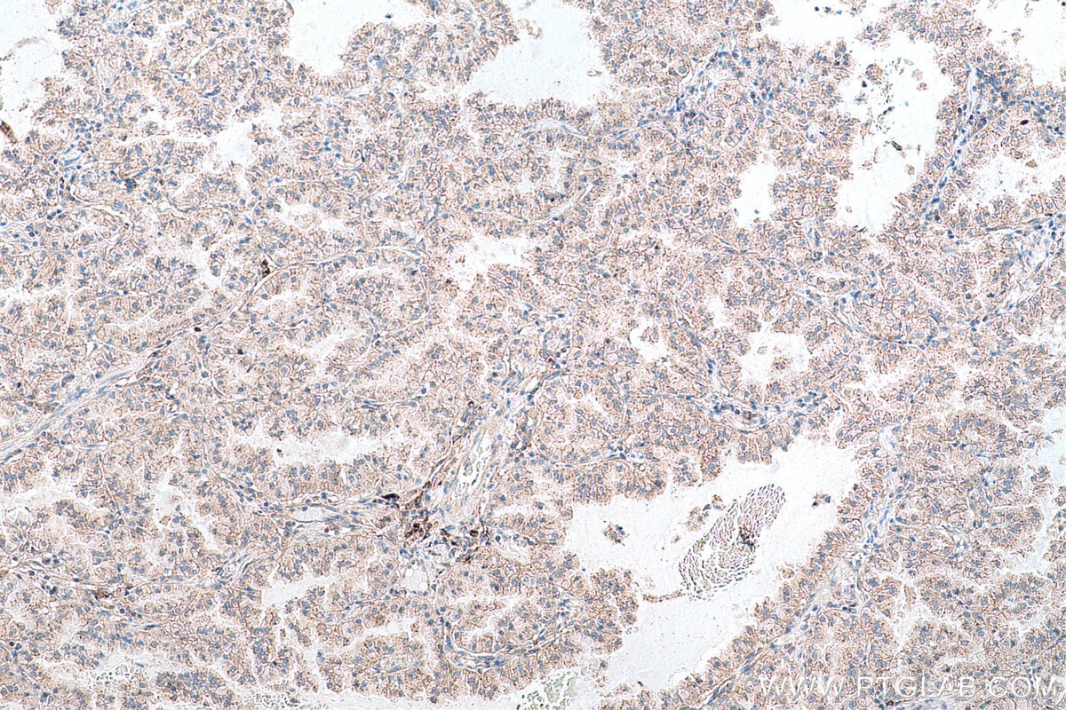 Immunohistochemical analysis of paraffin-embedded human lung cancer tissue slide using KHC0703 (SEC31A IHC Kit).