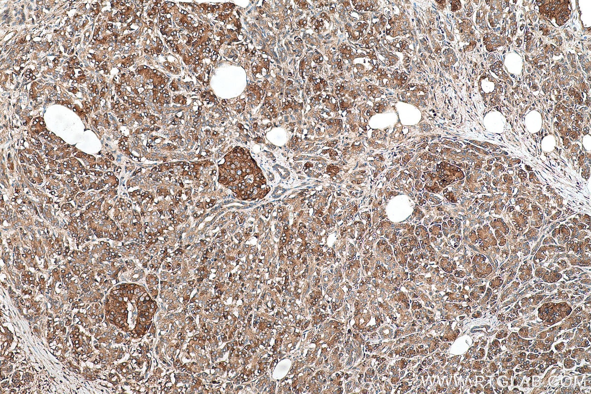 Immunohistochemical analysis of paraffin-embedded human pancreas cancer tissue slide using KHC0703 (SEC31A IHC Kit).