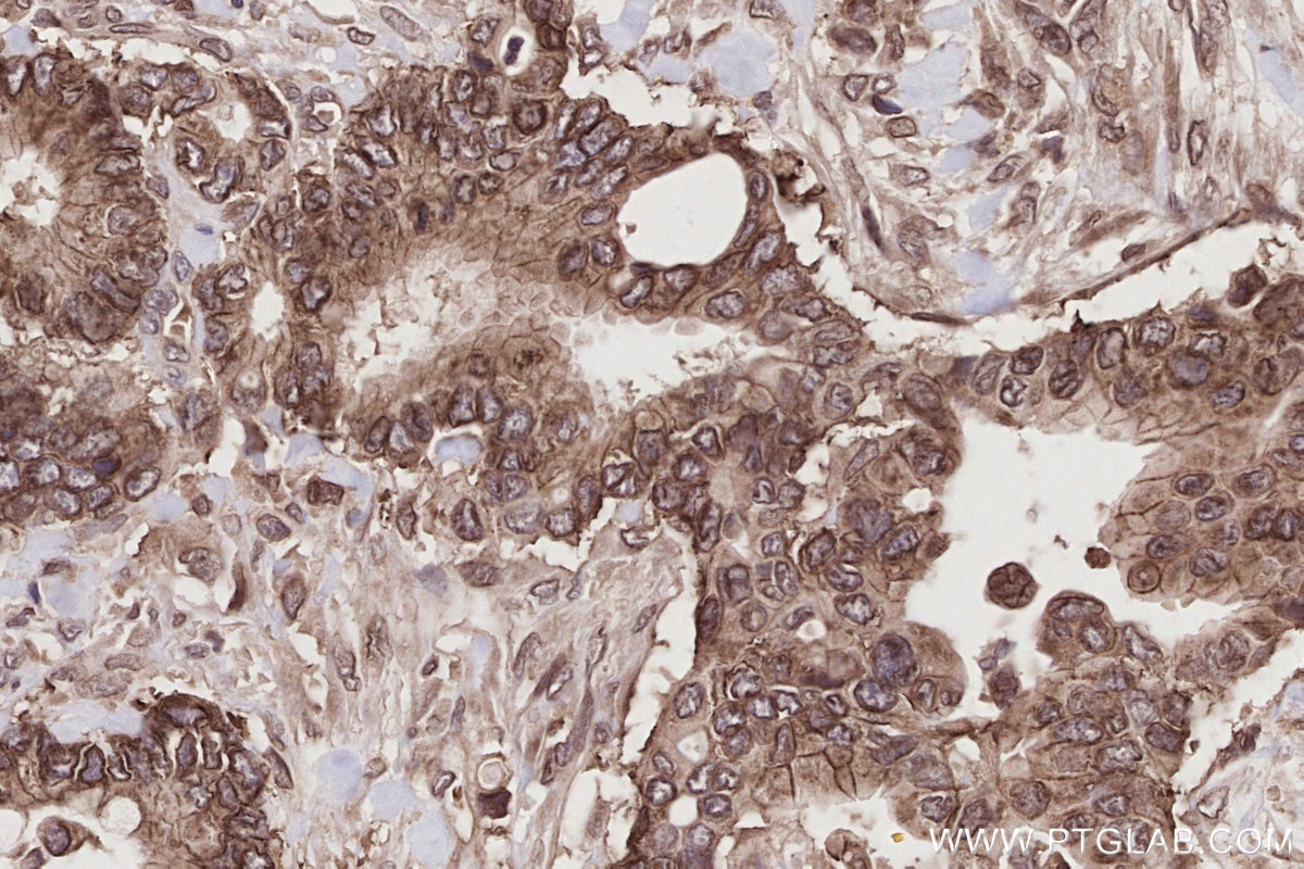 Immunohistochemical analysis of paraffin-embedded human rectal cancer tissue slide using KHC2789 (SEH1L IHC Kit).