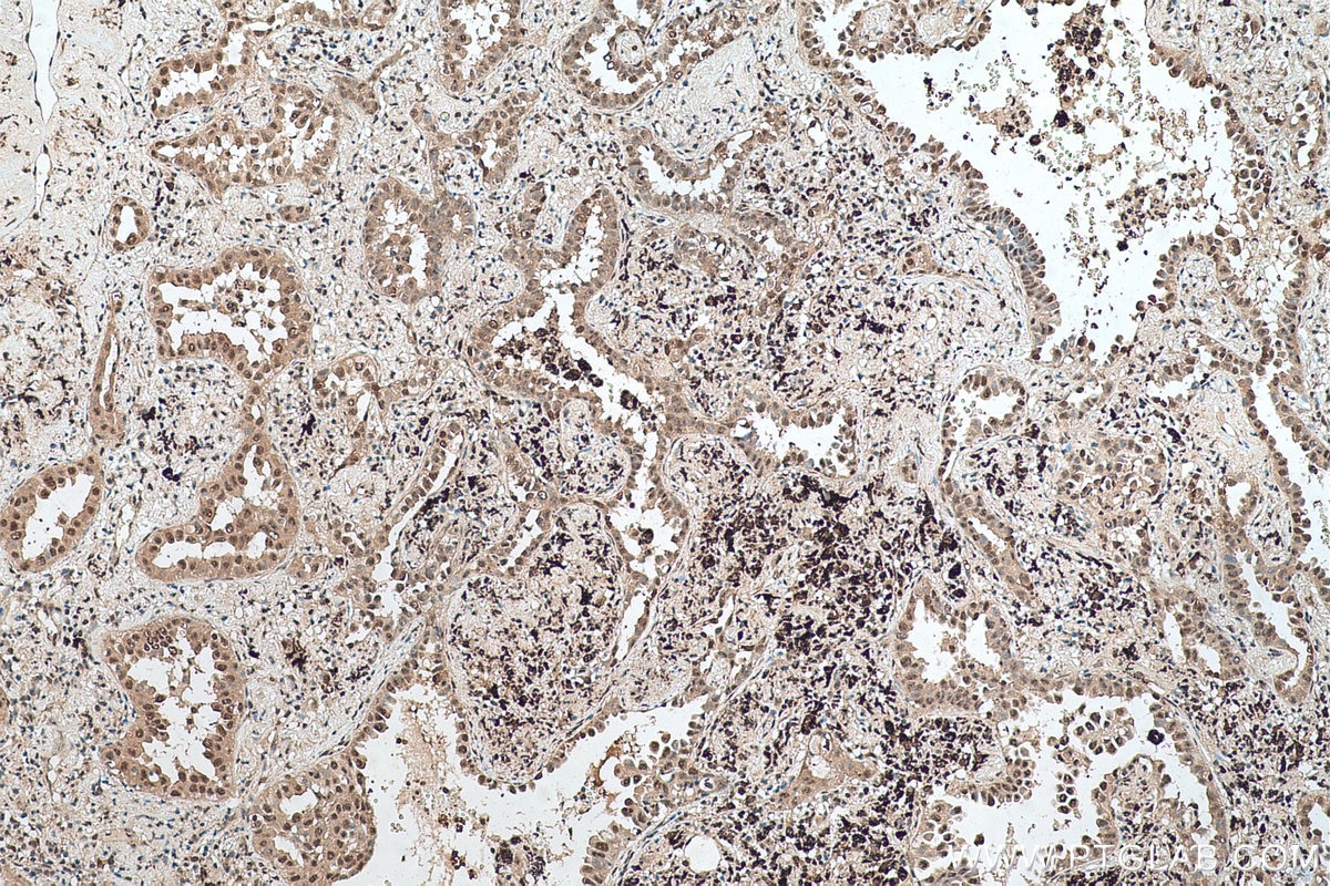 Immunohistochemical analysis of paraffin-embedded human lung cancer tissue slide using KHC0574 (SELENBP1 IHC Kit).