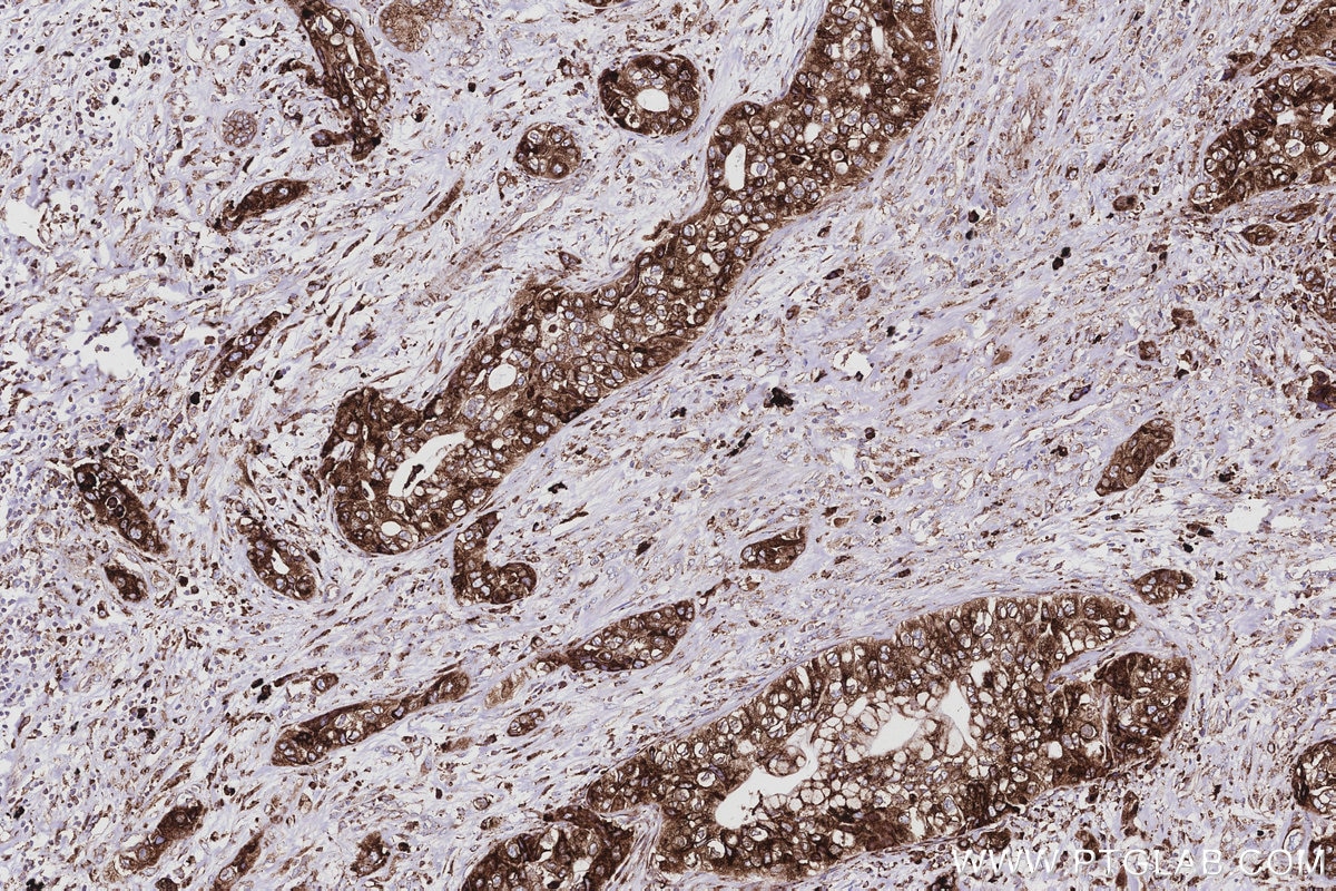 Immunohistochemical analysis of paraffin-embedded human pancreas cancer tissue slide using KHC2985 (SENP1 IHC Kit).