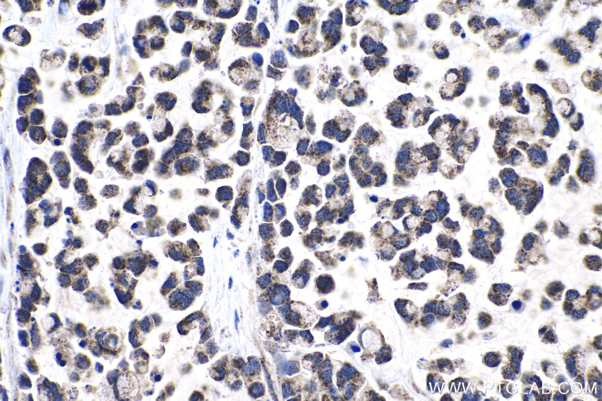 Immunohistochemical analysis of paraffin-embedded human colon cancer tissue slide using KHC1024 (SENP8 IHC Kit).