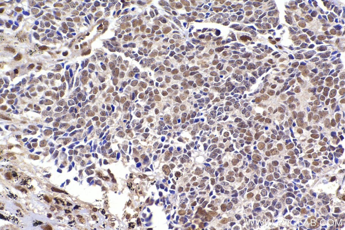 Immunohistochemical analysis of paraffin-embedded human lung cancer tissue slide using KHC2293 (SEPHS1 IHC Kit).