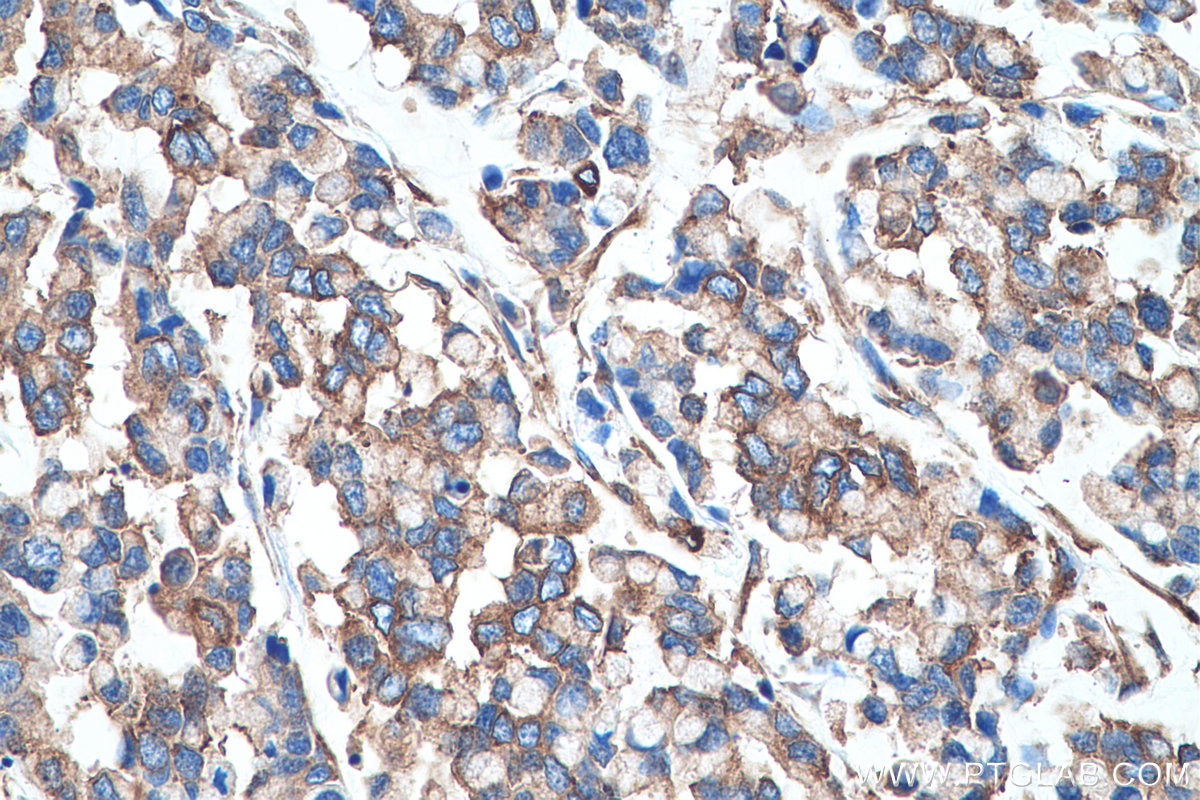 Immunohistochemical analysis of paraffin-embedded human colon cancer tissue slide using KHC0726 (SEPTIN2 IHC Kit).
