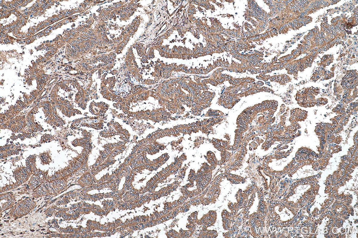 Immunohistochemical analysis of paraffin-embedded human ovary tumor tissue slide using KHC0726 (SEPTIN2 IHC Kit).