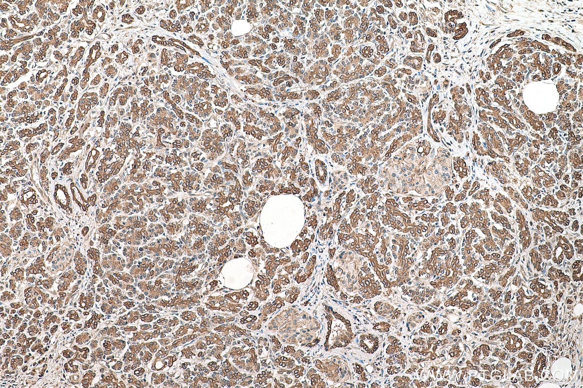 Immunohistochemical analysis of paraffin-embedded human pancreas cancer tissue slide using KHC0738 (SEPTIN9 IHC Kit).