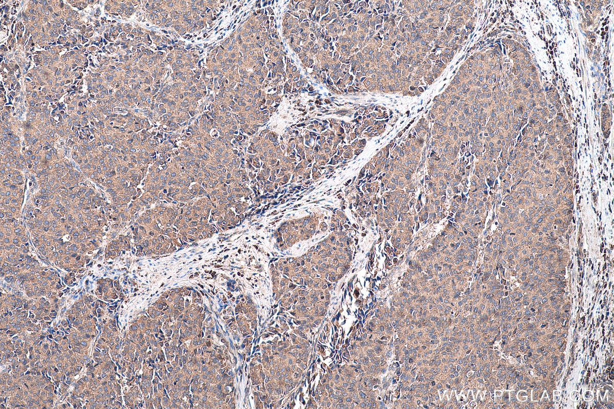 Immunohistochemical analysis of paraffin-embedded human stomach cancer tissue slide using KHC0738 (SEPTIN9 IHC Kit).