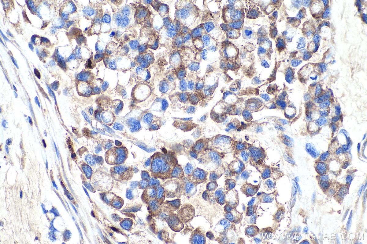 Immunohistochemical analysis of paraffin-embedded human colon cancer tissue slide using KHC0458 (Alpha Antichymotrypsin IHC Kit).