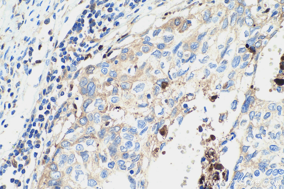 Immunohistochemical analysis of paraffin-embedded human cervical cancer tissue slide using KHC0458 (Alpha Antichymotrypsin IHC Kit).