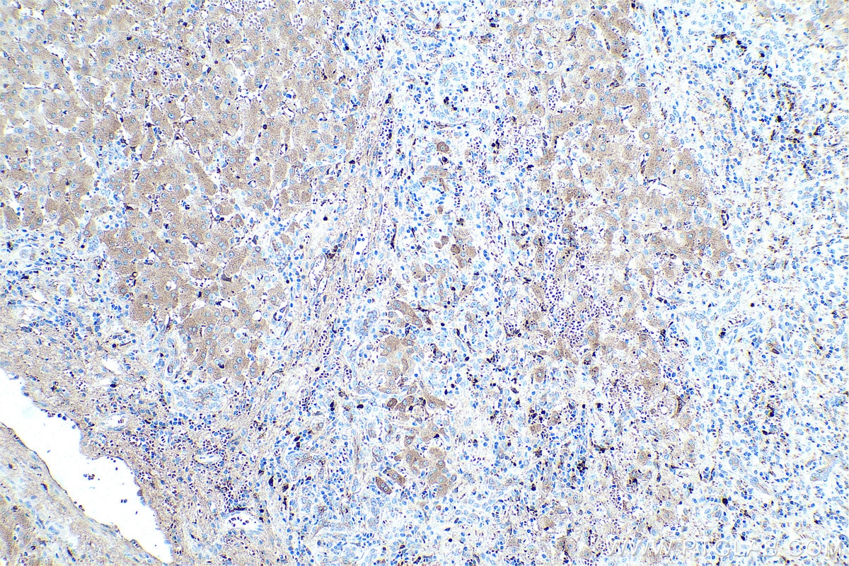 Immunohistochemical analysis of paraffin-embedded human liver cancer tissue slide using KHC0458 (Alpha Antichymotrypsin IHC Kit).