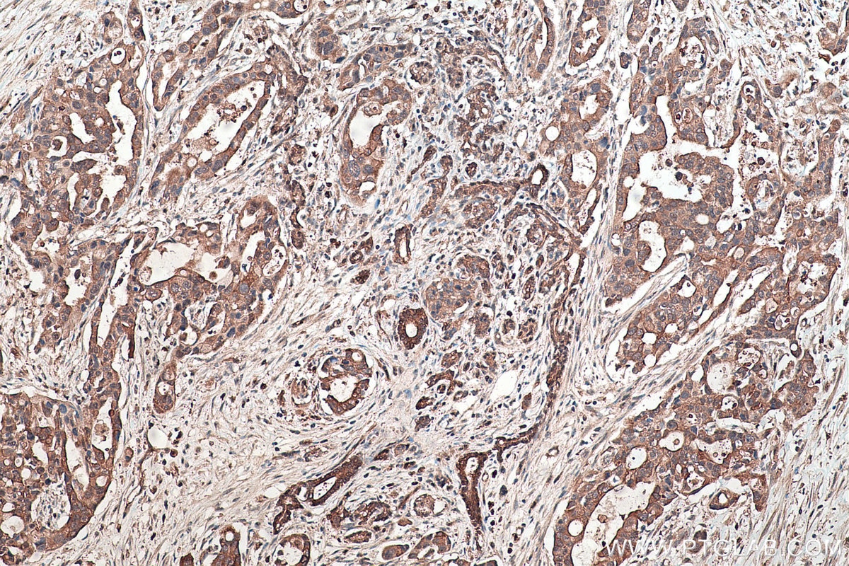 Immunohistochemical analysis of paraffin-embedded human pancreas cancer tissue slide using KHC0459 (SERPINB8 IHC Kit).