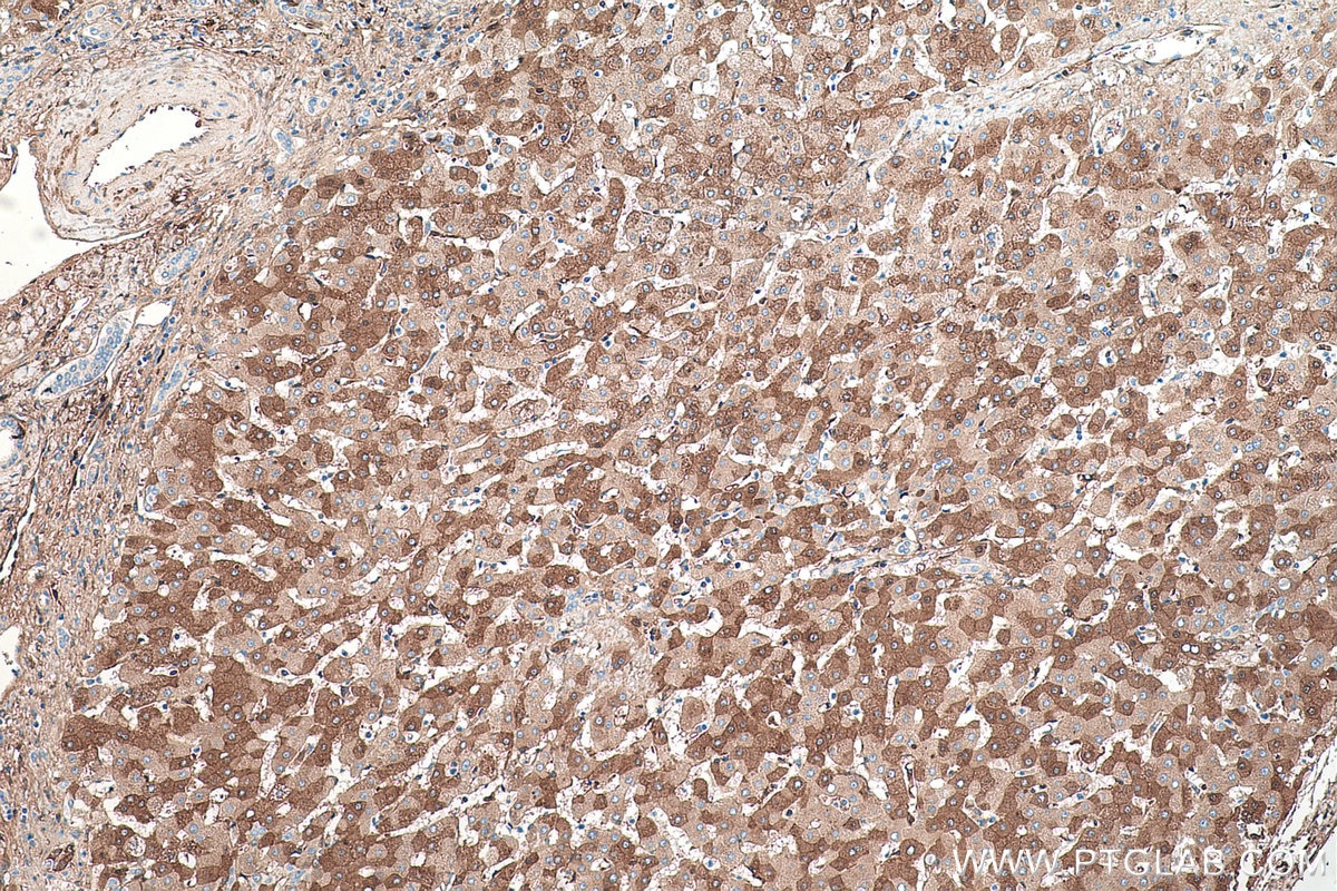Immunohistochemical analysis of paraffin-embedded human liver cancer tissue slide using KHC0460 (SERPINC1 IHC Kit).