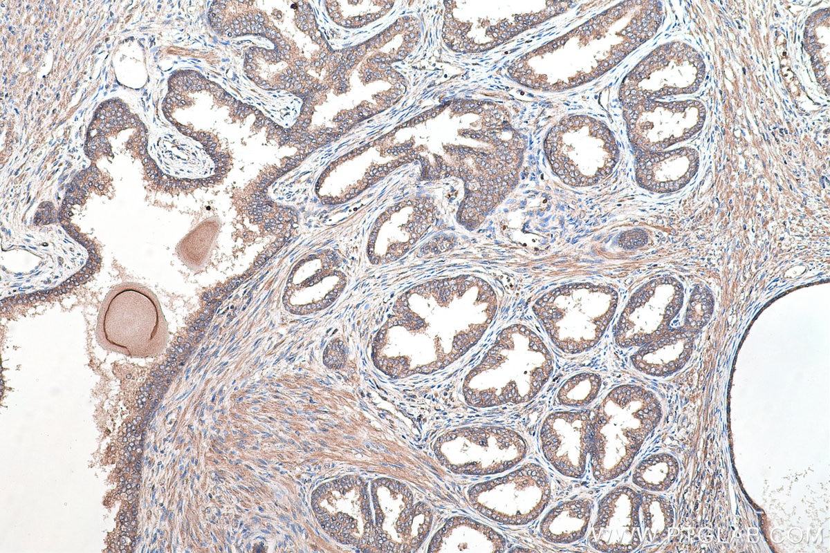 Immunohistochemical analysis of paraffin-embedded human prostate cancer tissue slide using KHC0461 (SERPINE1 IHC Kit).