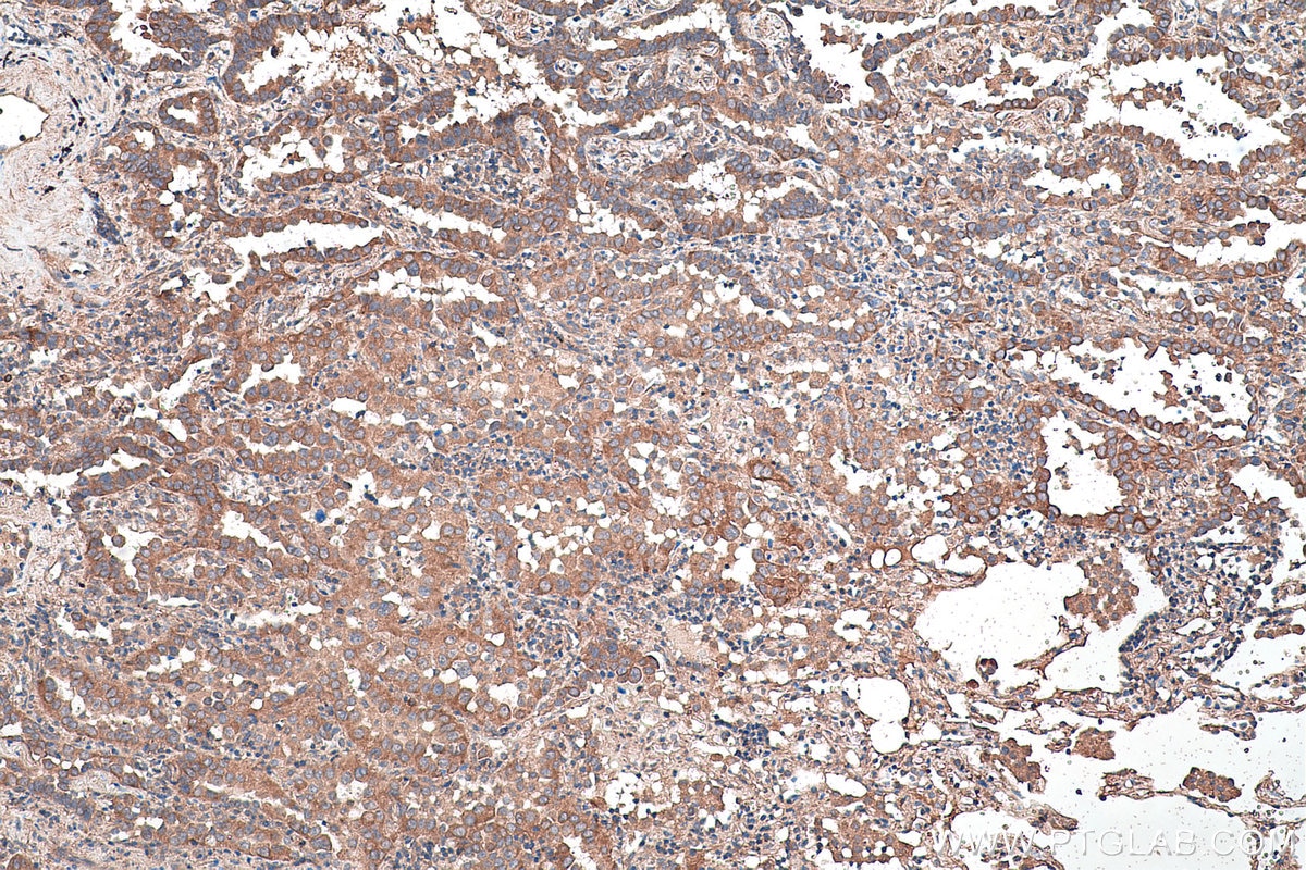 Immunohistochemical analysis of paraffin-embedded human lung cancer tissue slide using KHC0461 (SERPINE1 IHC Kit).