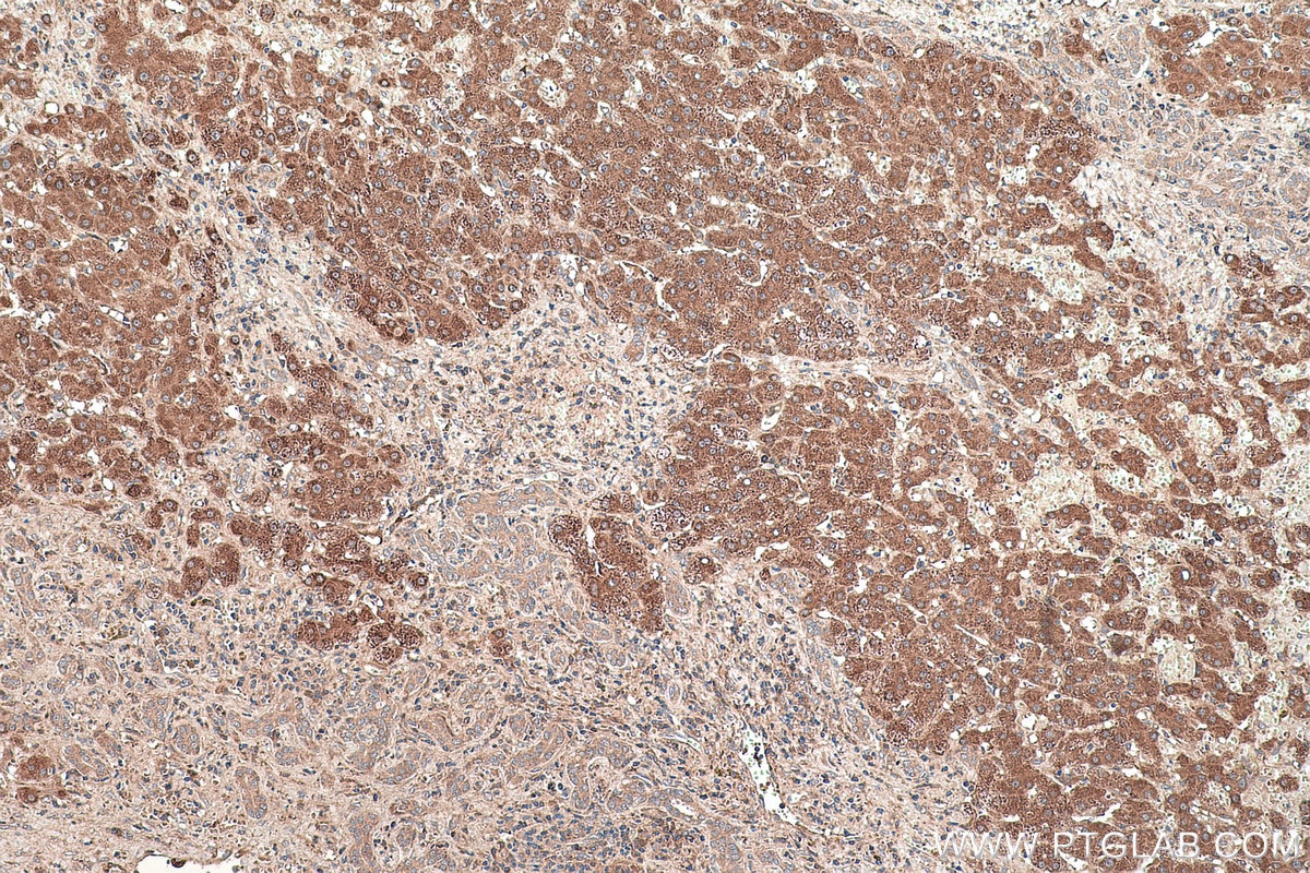 Immunohistochemical analysis of paraffin-embedded human liver cancer tissue slide using KHC0462 (SERPINF1/PEDF IHC Kit).