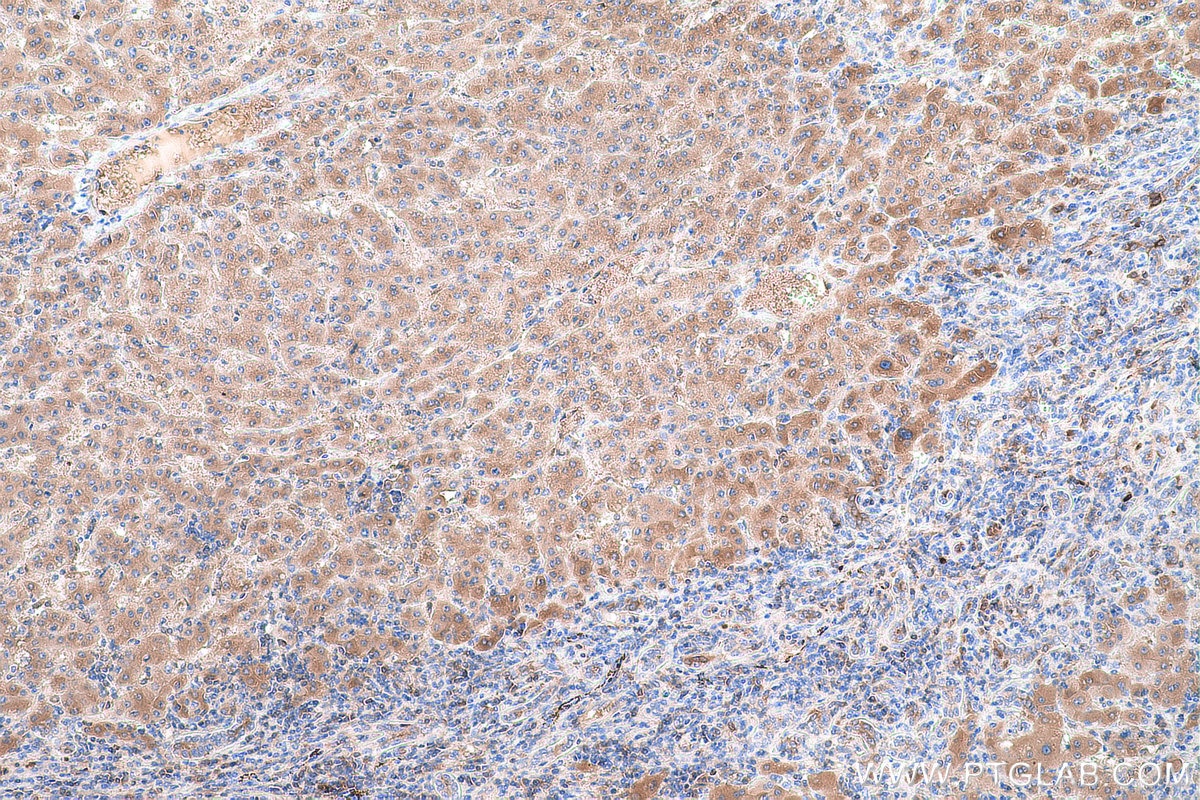 Immunohistochemical analysis of paraffin-embedded human liver cancer tissue slide using KHC0741 (SERPING1 IHC Kit).