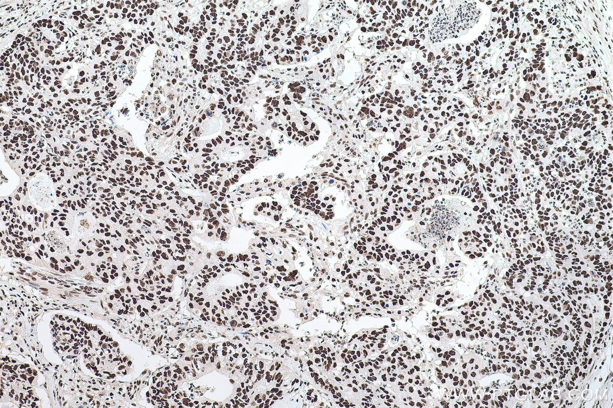 Immunohistochemical analysis of paraffin-embedded human stomach cancer tissue slide using KHC0696 (SET IHC Kit).