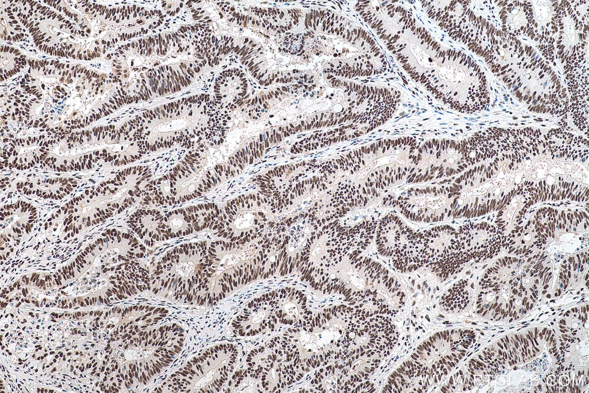 Immunohistochemical analysis of paraffin-embedded human colon cancer tissue slide using KHC0696 (SET IHC Kit).