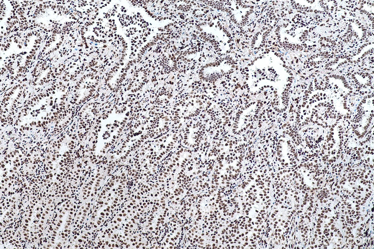 Immunohistochemical analysis of paraffin-embedded human lung cancer tissue slide using KHC0696 (SET IHC Kit).