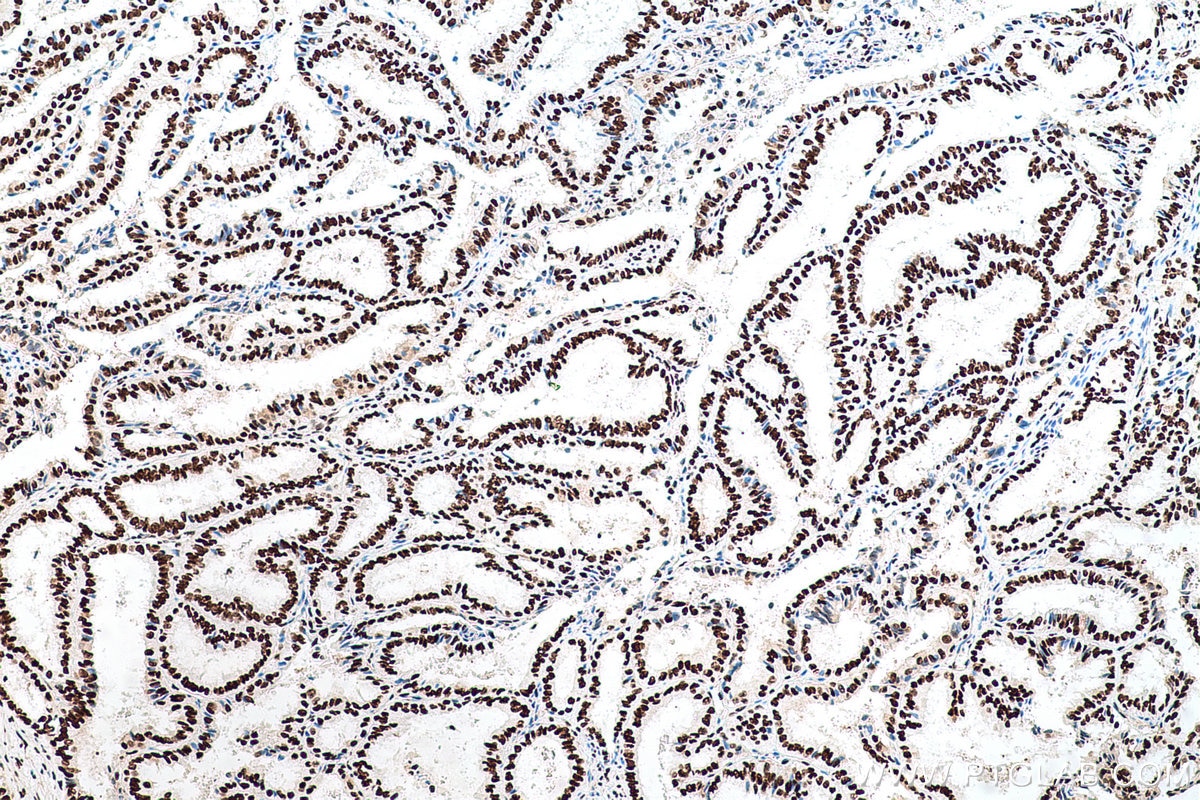 Immunohistochemical analysis of paraffin-embedded human ovary tumor tissue slide using KHC0696 (SET IHC Kit).