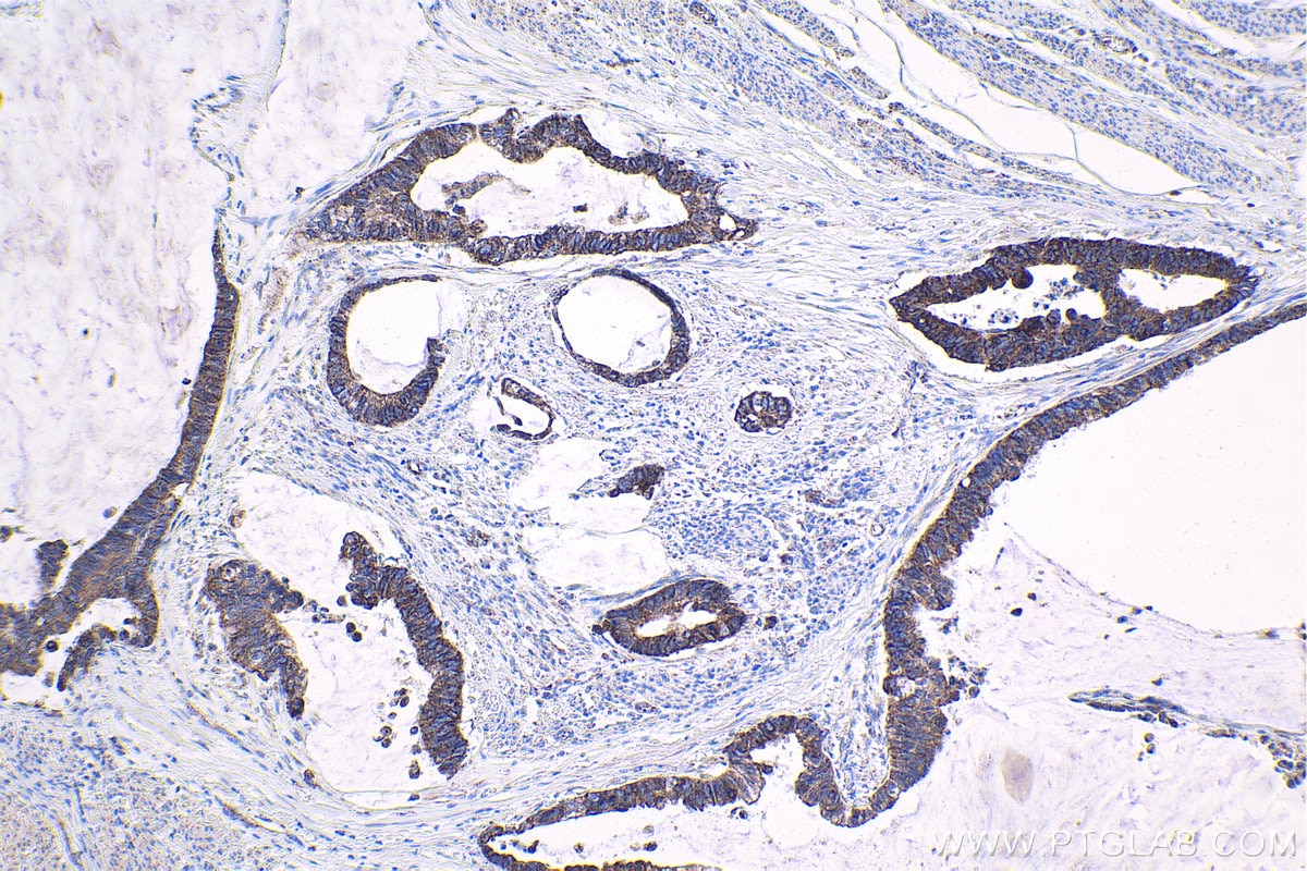 Immunohistochemical analysis of paraffin-embedded human urothelial carcinoma tissue slide using KHC1807 (SETD3 IHC Kit).