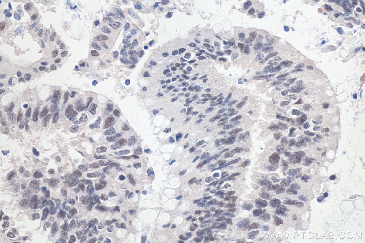 Immunohistochemical analysis of paraffin-embedded human colon cancer tissue slide using KHC0067 (SETDB1 IHC Kit).