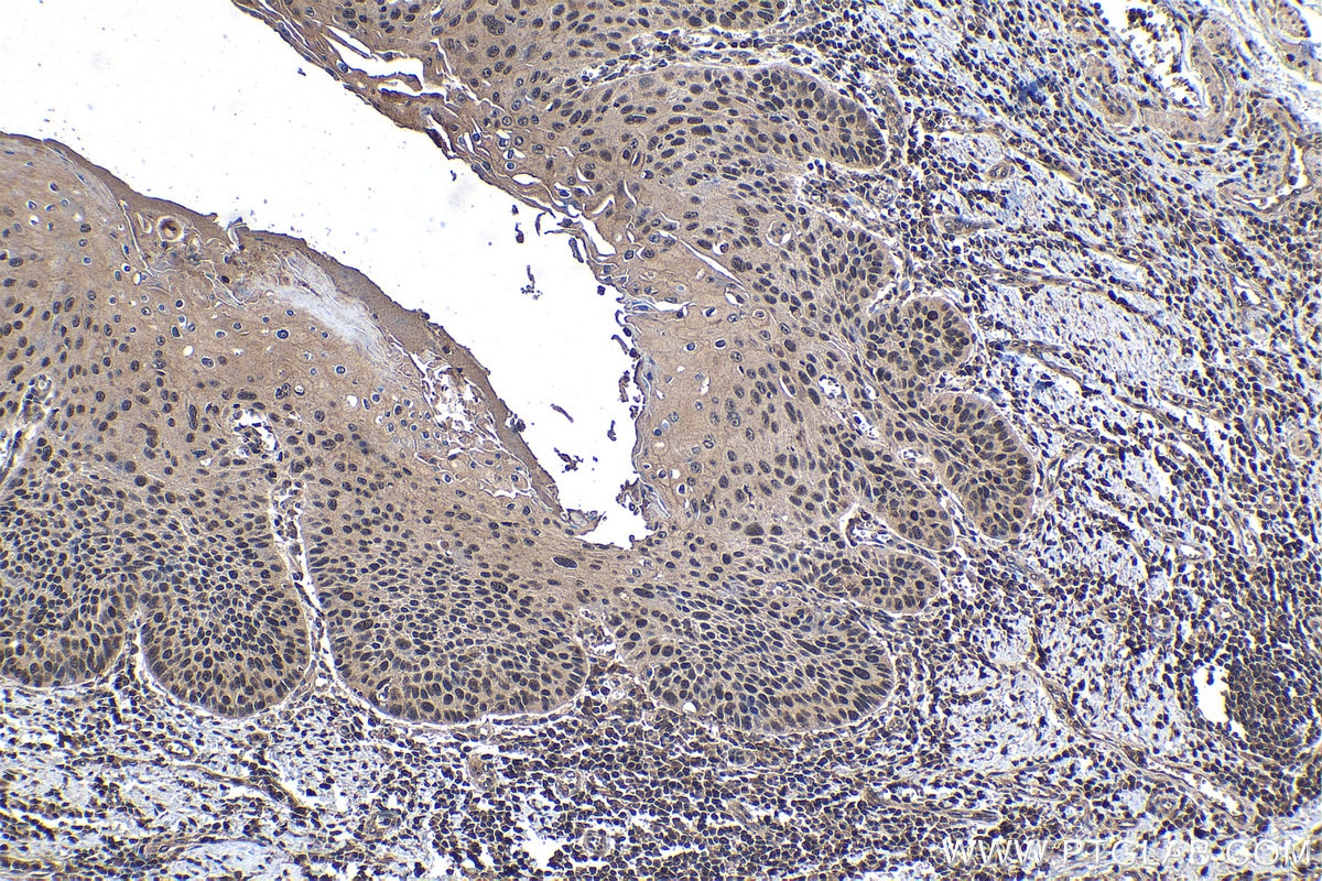 Immunohistochemical analysis of paraffin-embedded human oesophagus cancer tissue slide using KHC1438 (SF1 IHC Kit).
