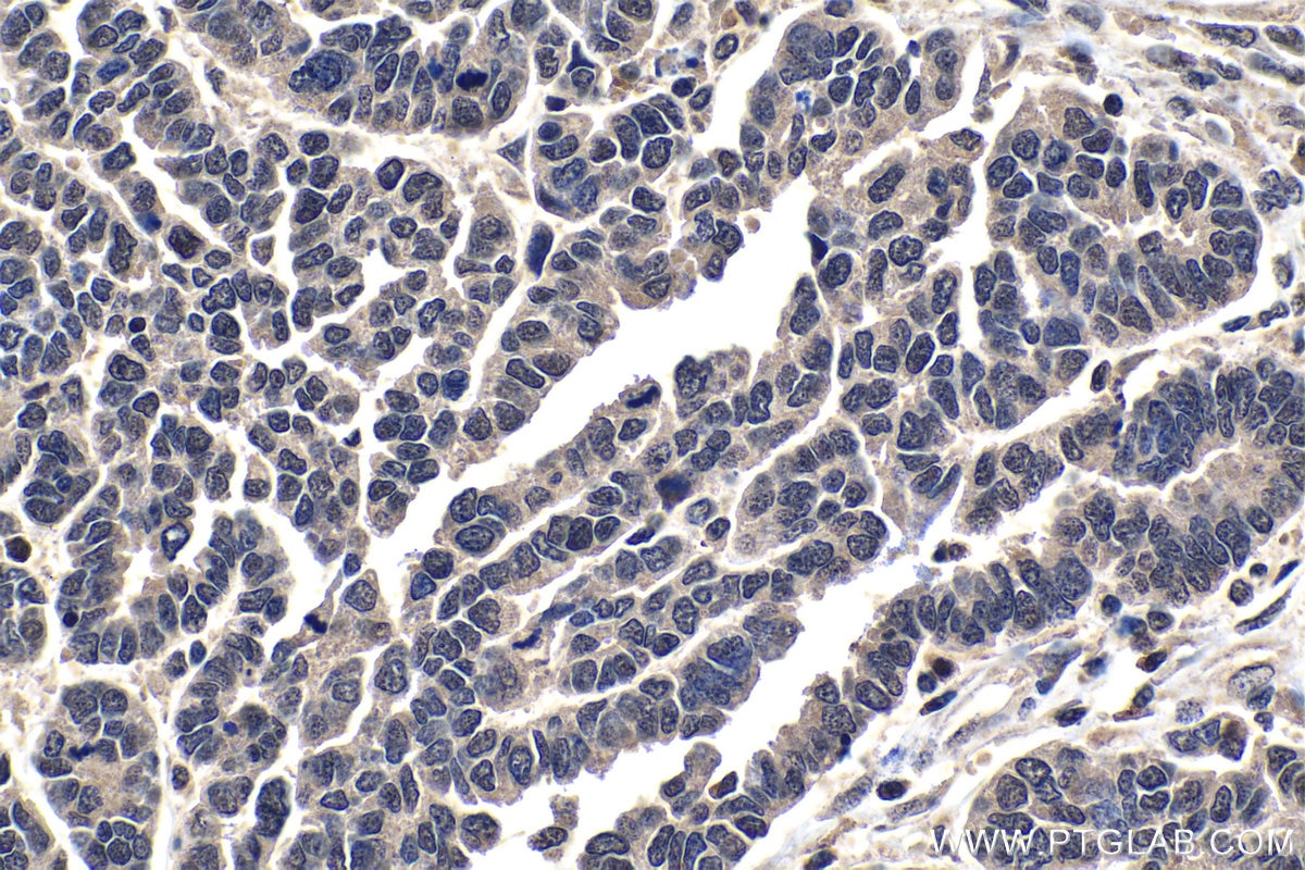Immunohistochemical analysis of paraffin-embedded human ovary tumor tissue slide using KHC1438 (SF1 IHC Kit).