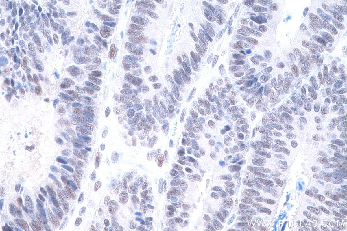 Immunohistochemical analysis of paraffin-embedded human colon cancer tissue slide using KHC0906 (SF3A1 IHC Kit).