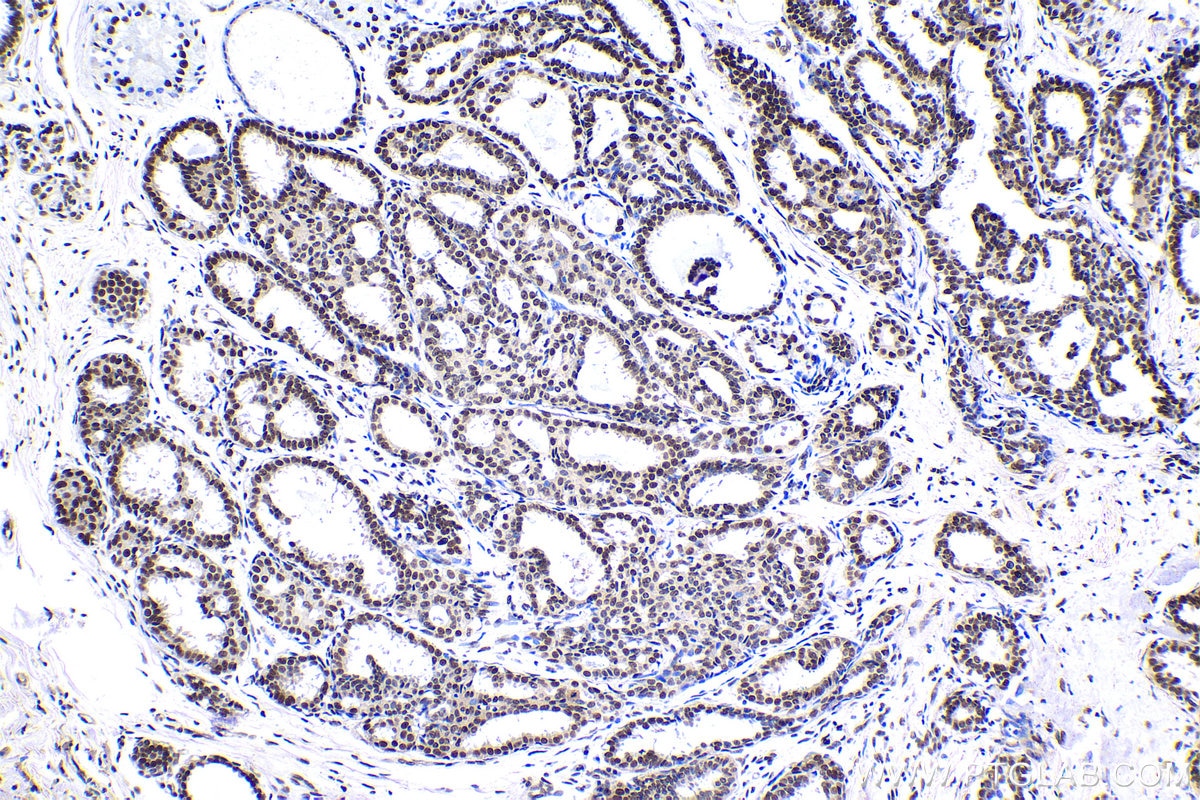 Immunohistochemical analysis of paraffin-embedded human breast cancer tissue slide using KHC1406 (SF3A3 IHC Kit).