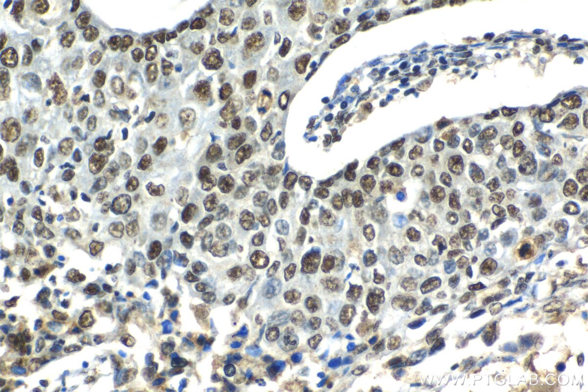 Immunohistochemical analysis of paraffin-embedded human lung cancer tissue slide using KHC1406 (SF3A3 IHC Kit).