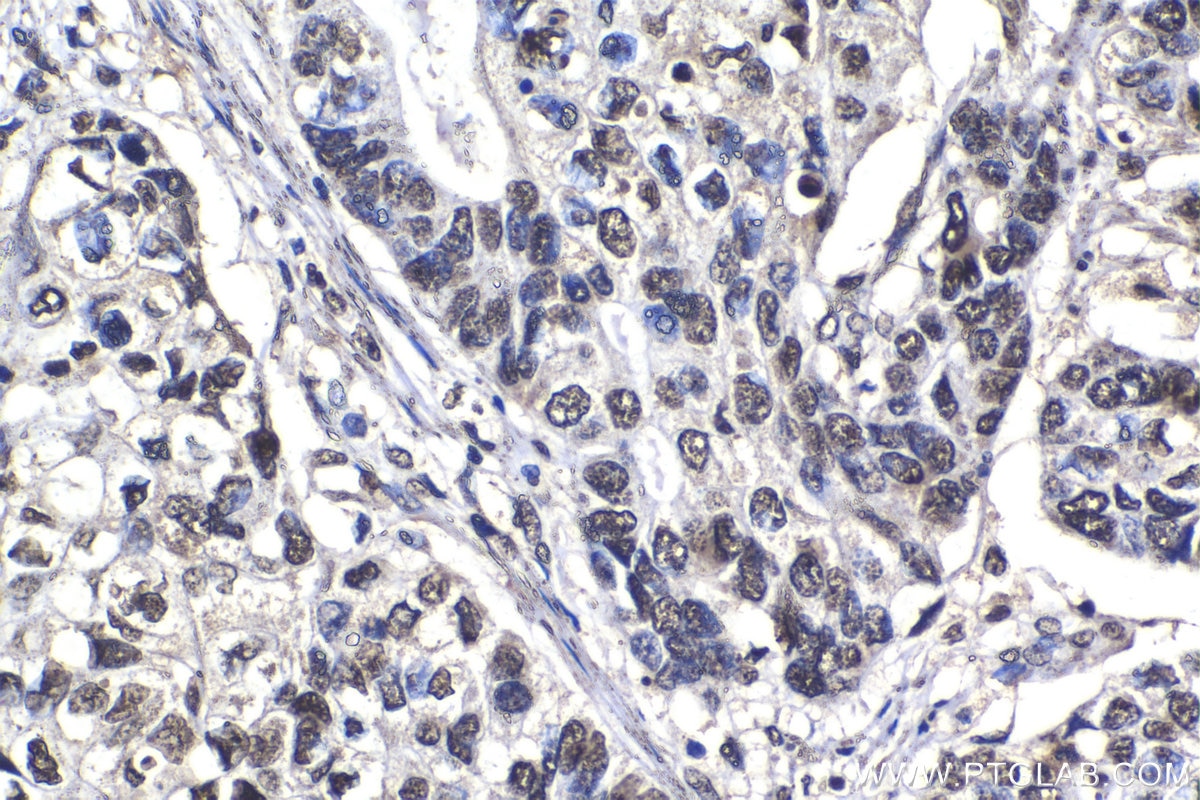 Immunohistochemical analysis of paraffin-embedded human stomach cancer tissue slide using KHC1406 (SF3A3 IHC Kit).