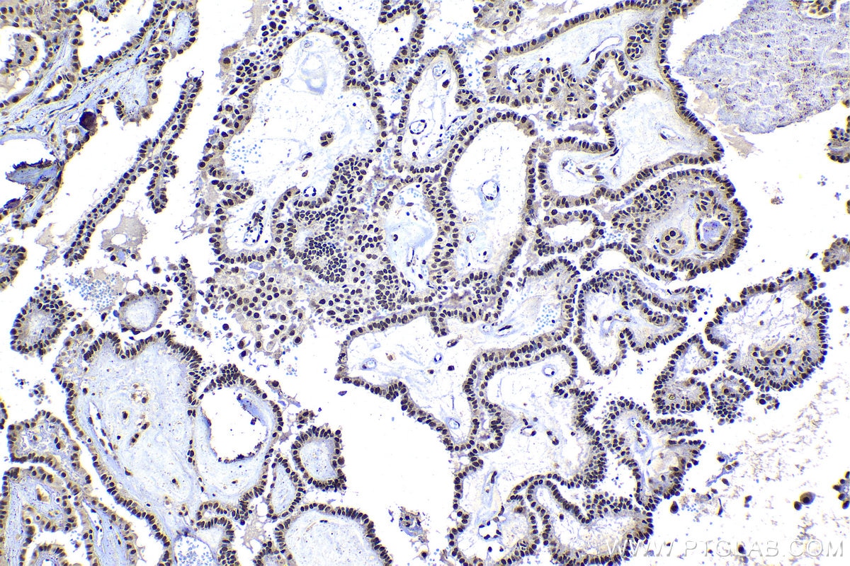 Immunohistochemical analysis of paraffin-embedded human thyroid cancer tissue slide using KHC1406 (SF3A3 IHC Kit).