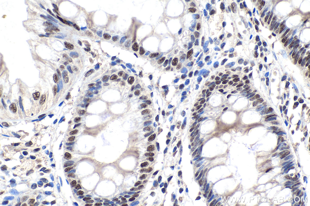 Immunohistochemical analysis of paraffin-embedded human colon tissue slide using KHC1077 (SF3B1 IHC Kit).