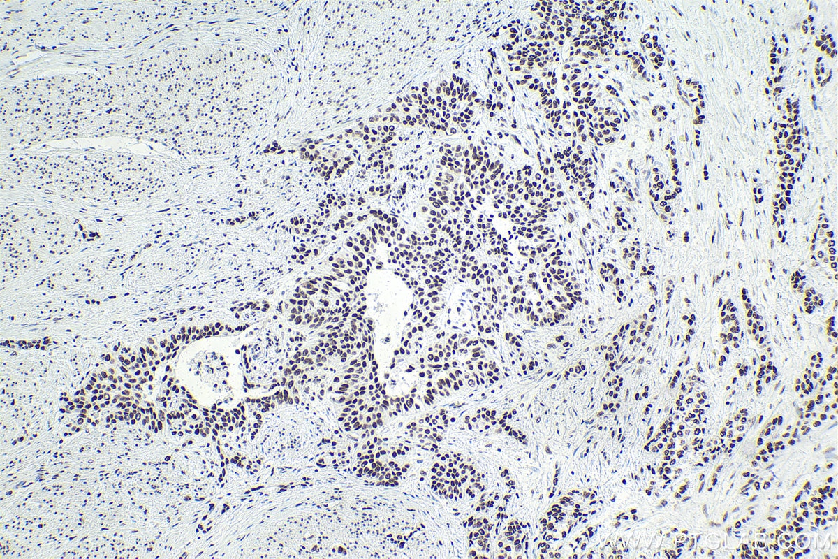 Immunohistochemical analysis of paraffin-embedded human urothelial carcinoma tissue slide using KHC1751 (SF3B3 IHC Kit).