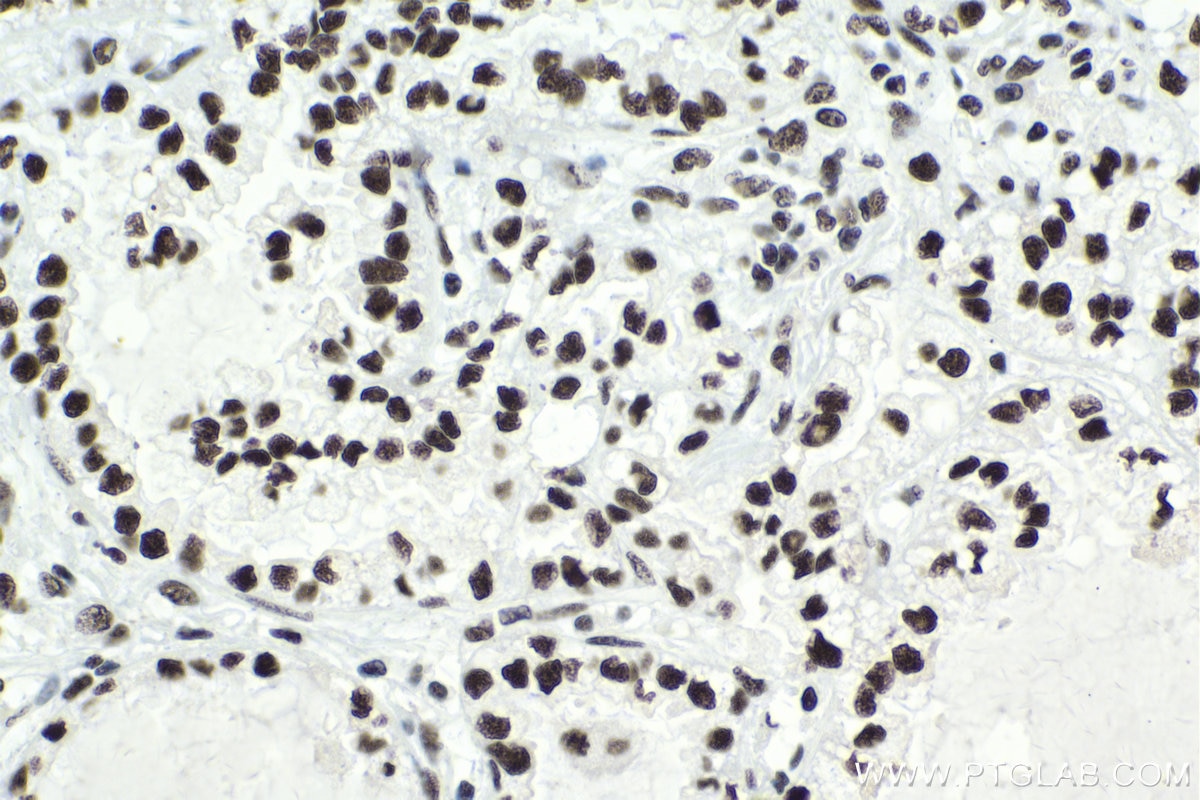 Immunohistochemical analysis of paraffin-embedded human lung cancer tissue slide using KHC1751 (SF3B3 IHC Kit).