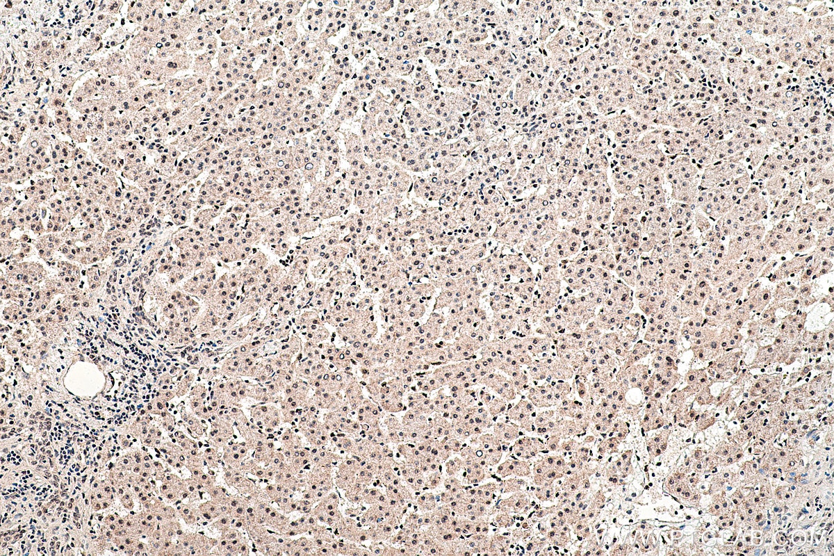 Immunohistochemical analysis of paraffin-embedded human liver cancer tissue slide using KHC0463 (SF3B5 IHC Kit).