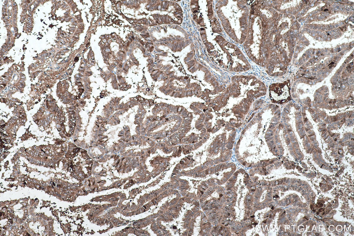 Immunohistochemical analysis of paraffin-embedded human ovary tumor tissue slide using KHC0464 (14-3-3 Sigma IHC Kit).