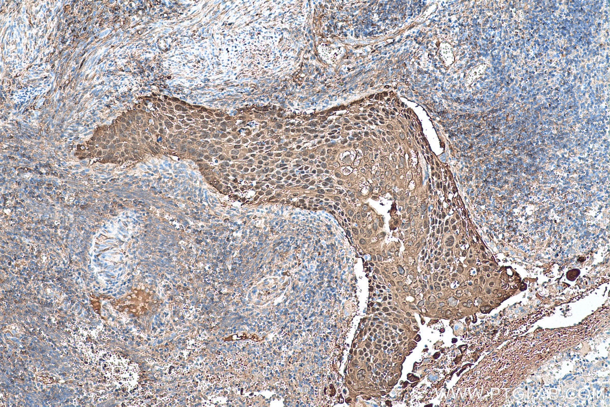 Immunohistochemical analysis of paraffin-embedded human cervical cancer tissue slide using KHC0464 (14-3-3 Sigma IHC Kit).