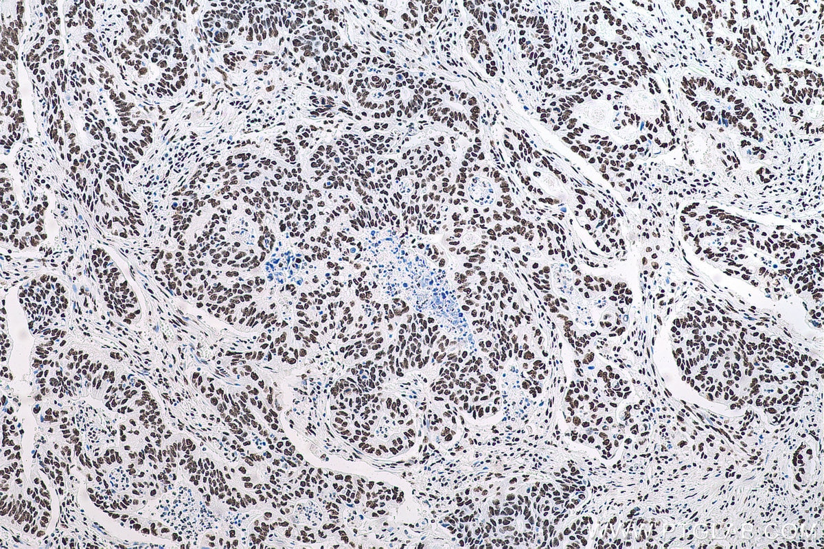 Immunohistochemical analysis of paraffin-embedded human stomach cancer tissue slide using KHC0710 (SFPQ IHC Kit).