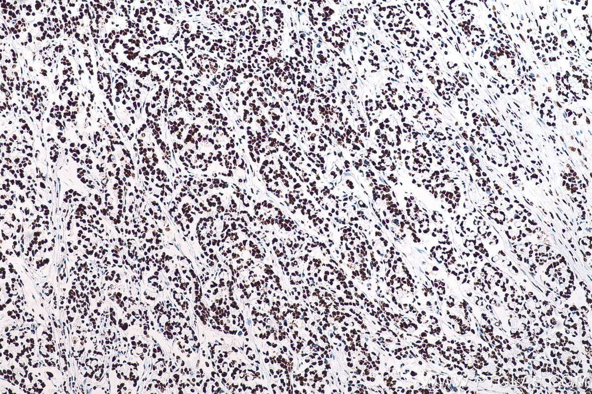 Immunohistochemical analysis of paraffin-embedded human colon cancer tissue slide using KHC0710 (SFPQ IHC Kit).