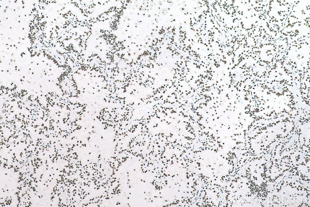 Immunohistochemical analysis of paraffin-embedded human lung cancer tissue slide using KHC0710 (SFPQ IHC Kit).